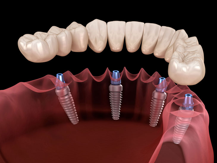 Методы имплантации при полном отсутствии зубов