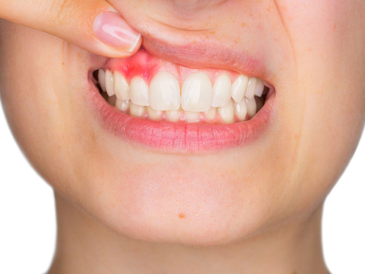 Зубной свищ после имплантации: как не допустить и чем лечить