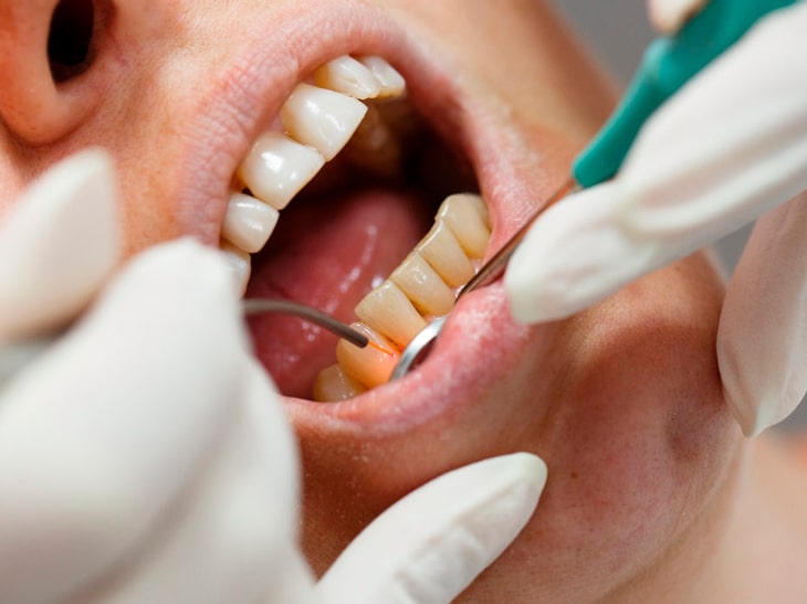 Имплантация зубов  при пародонтозе
