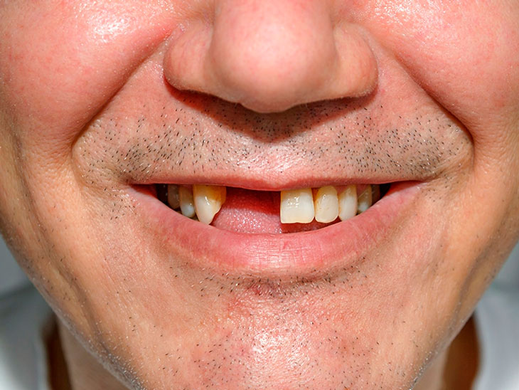 Каковы последствия отсутствия зубов во рту