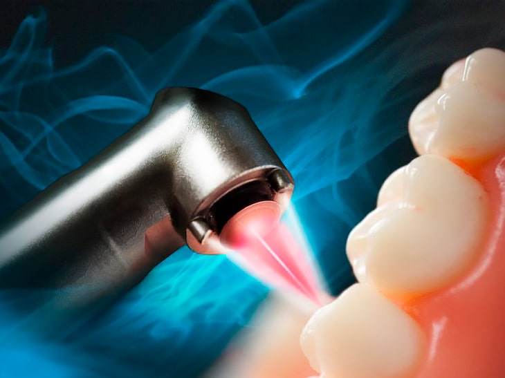 Как проходит лазерная имплантация зубов и какие у неё преимущества
