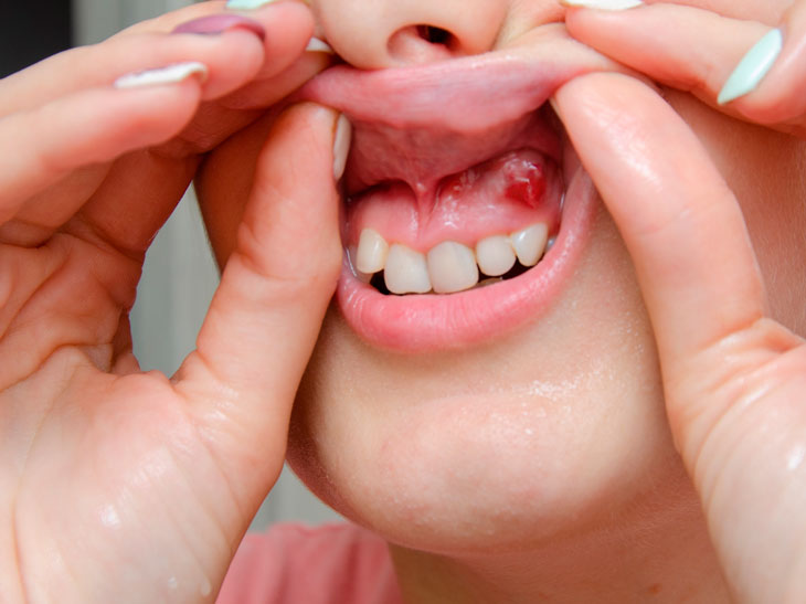 Киста зуба: лечить или удалять?