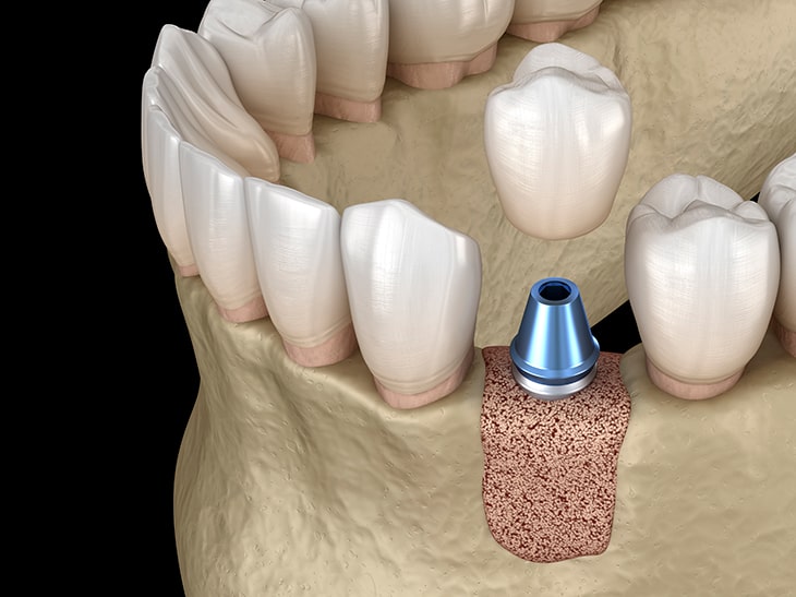 Костная пластика при имплантации зубов: виды, особенности, показания