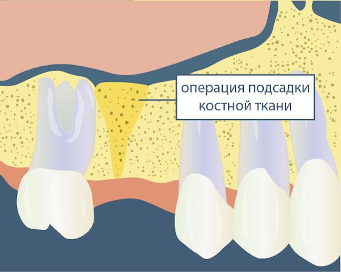Восстановление костной ткани -5 способов