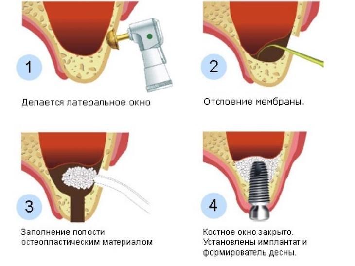 Восстановление костной ткани -5 способов