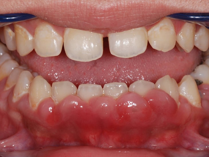Гиперплазия слизистой полости рта
