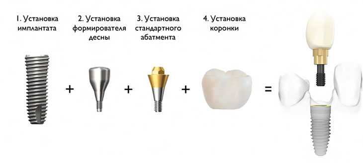 Составные части готового зуба