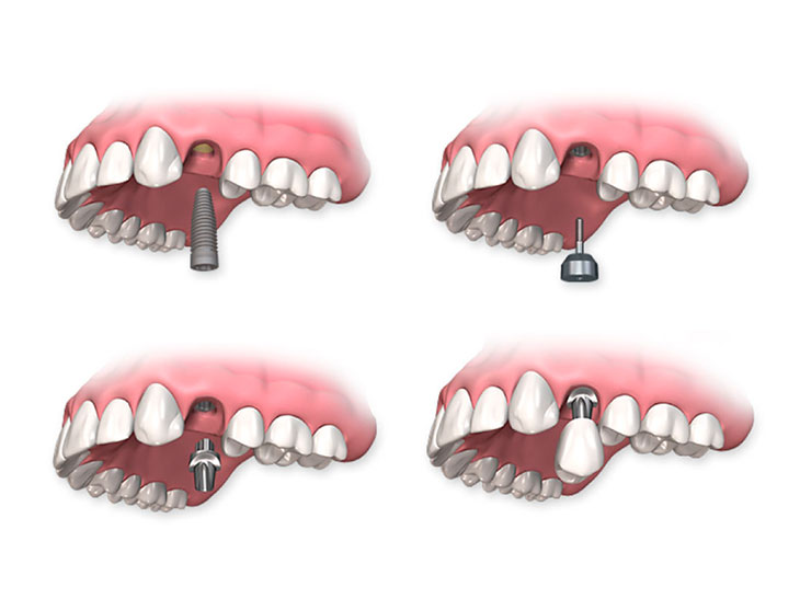 Этапы восстановления утраченного зуба