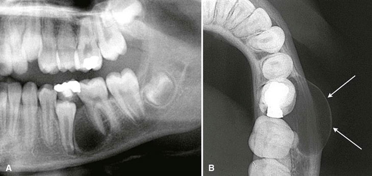 Как выглядят зубные кисты на рентгенограмме